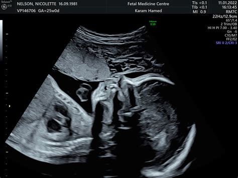what is cas ultrasound|Anomaly scan 20 weeks .
